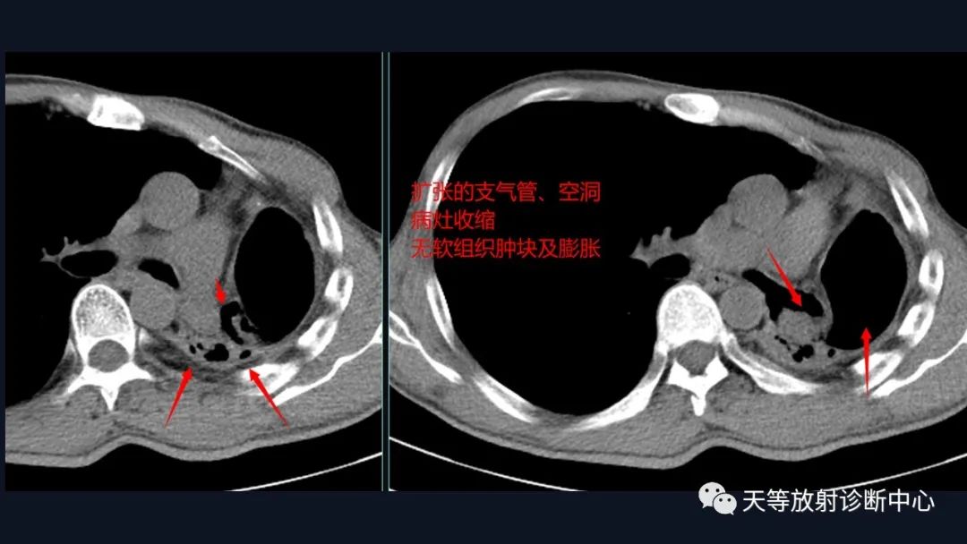 影像PPT - 【病例】肺结核1例CT影像征象分析-9 影像PPT - 【病例】肺结核1例CT影像征象分析-9