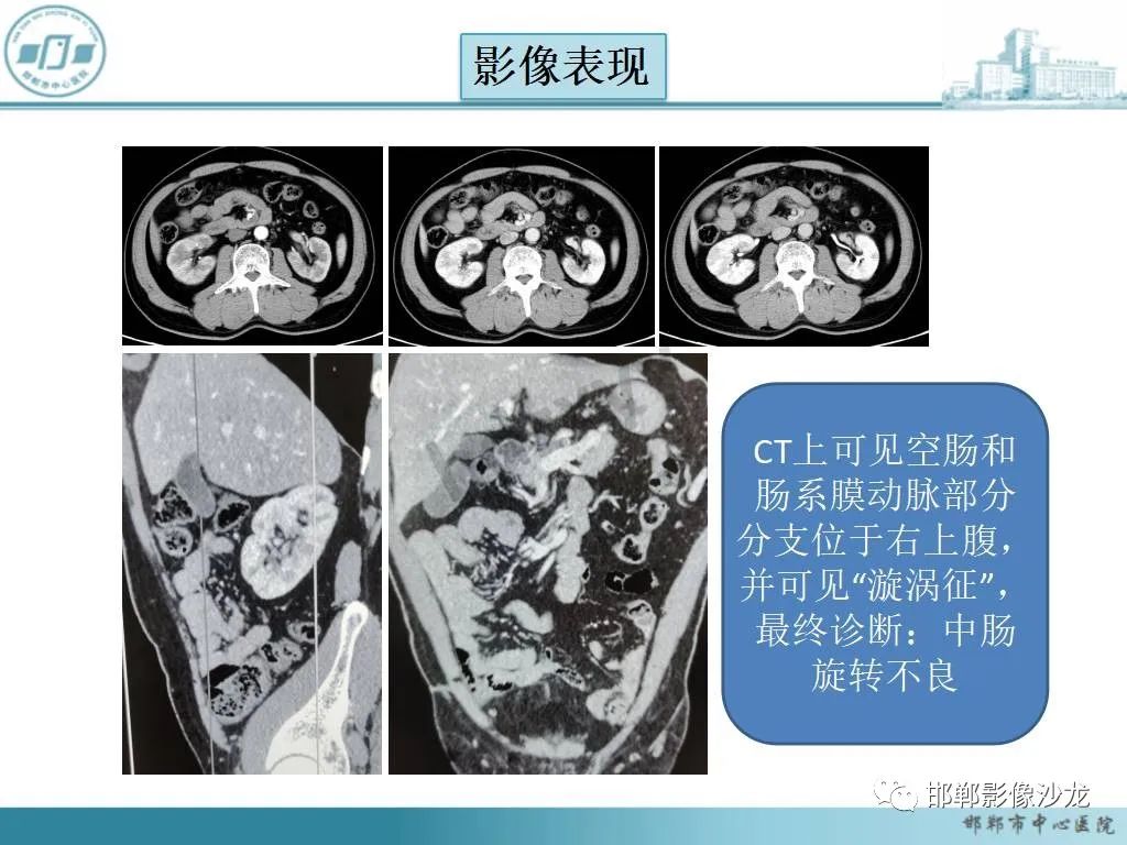 影像PPT - 【PPT】中肠旋转不良-9