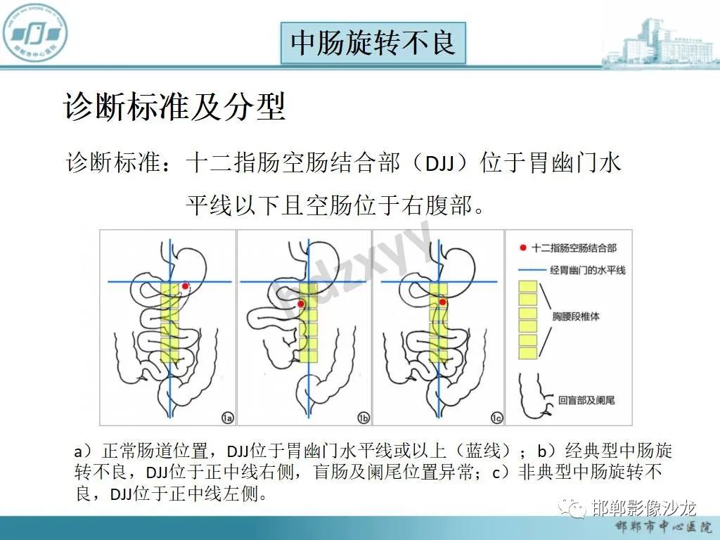 影像PPT - 【PPT】中肠旋转不良-14