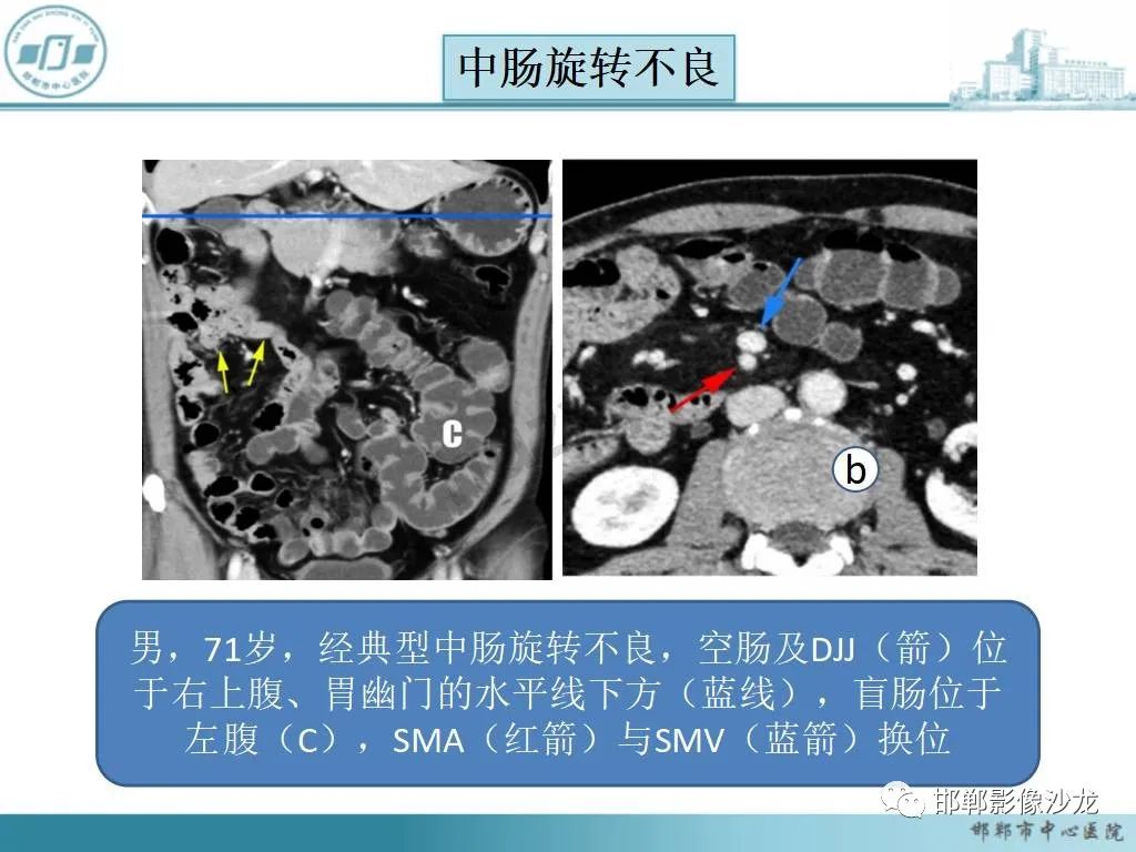 影像PPT - 【PPT】中肠旋转不良-17