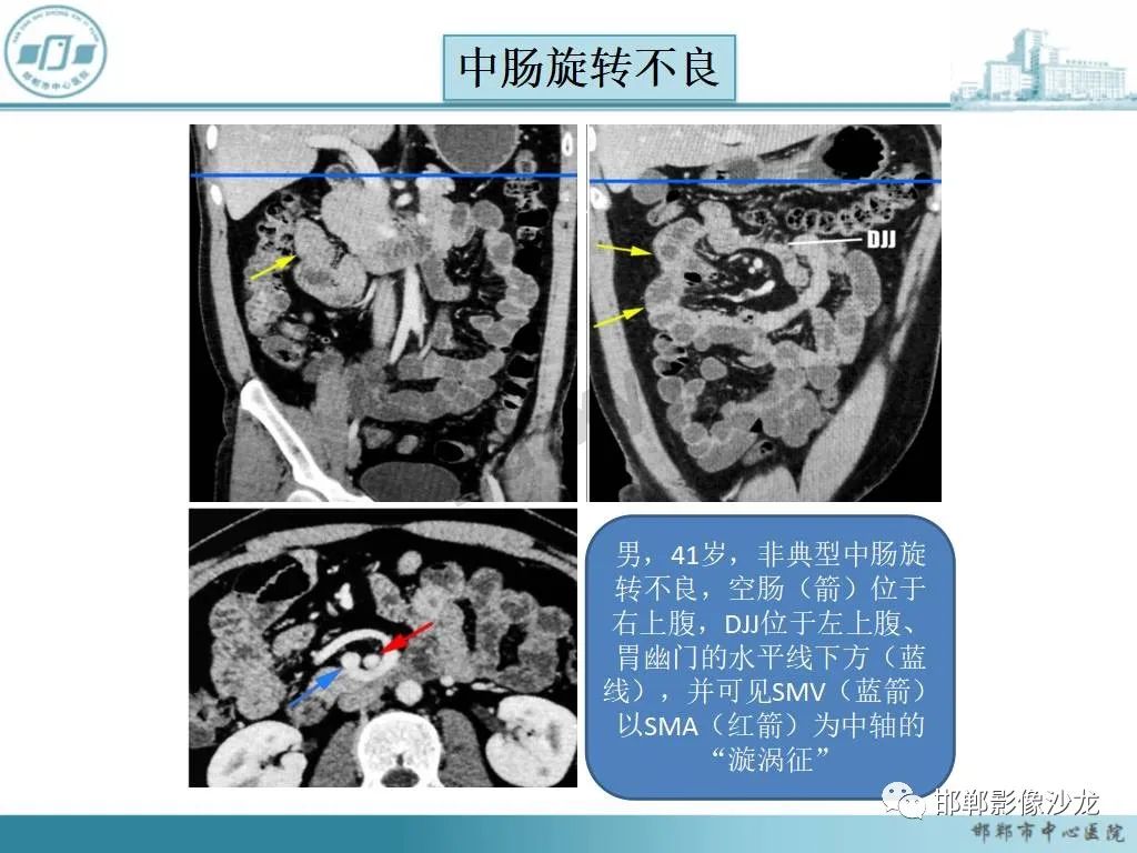 影像PPT - 【PPT】中肠旋转不良-18