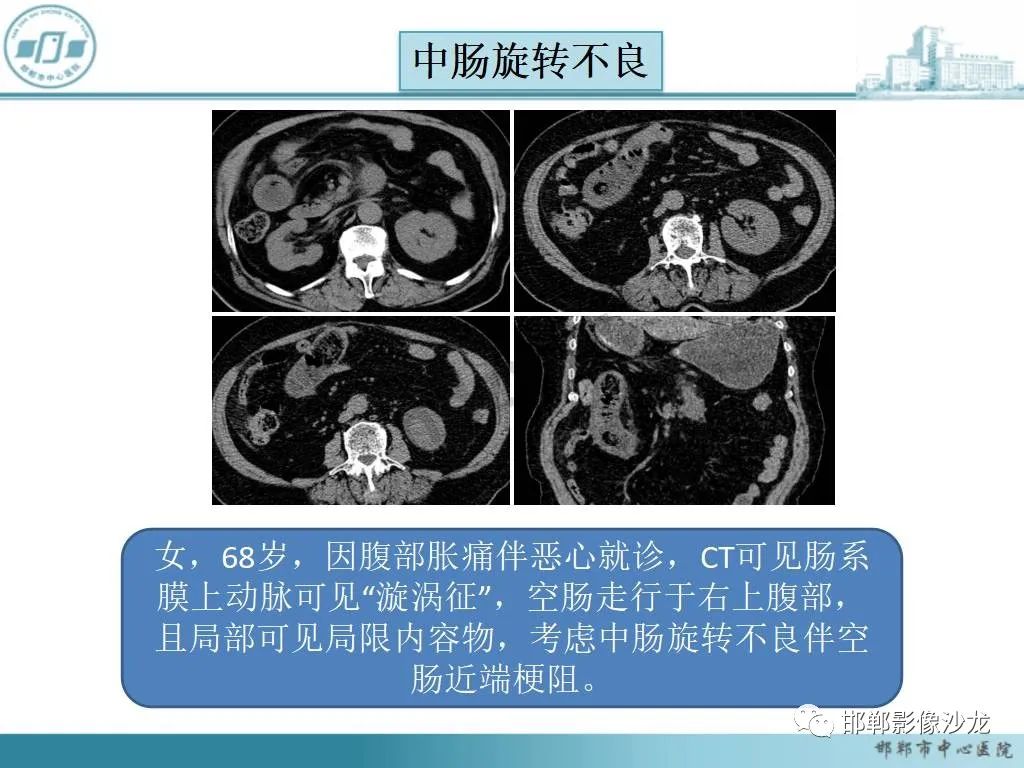 影像PPT - 【PPT】中肠旋转不良-19