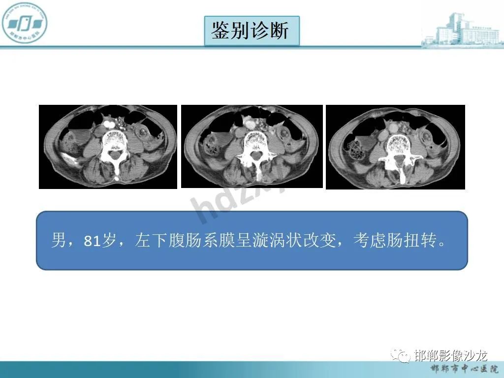 影像PPT - 【PPT】中肠旋转不良-22