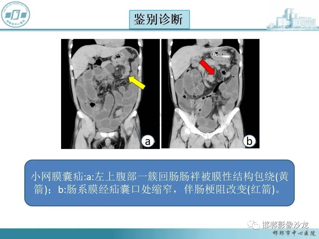 影像PPT - 【PPT】中肠旋转不良-25