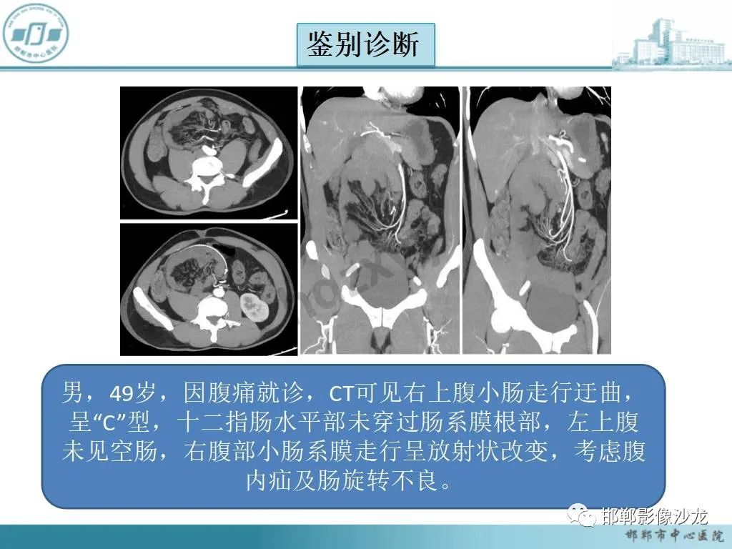 影像PPT - 【PPT】中肠旋转不良-26