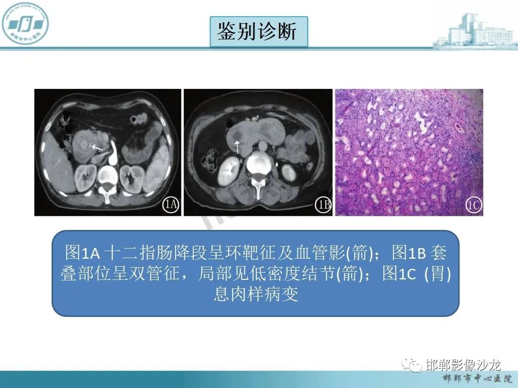影像PPT - 【PPT】中肠旋转不良-31