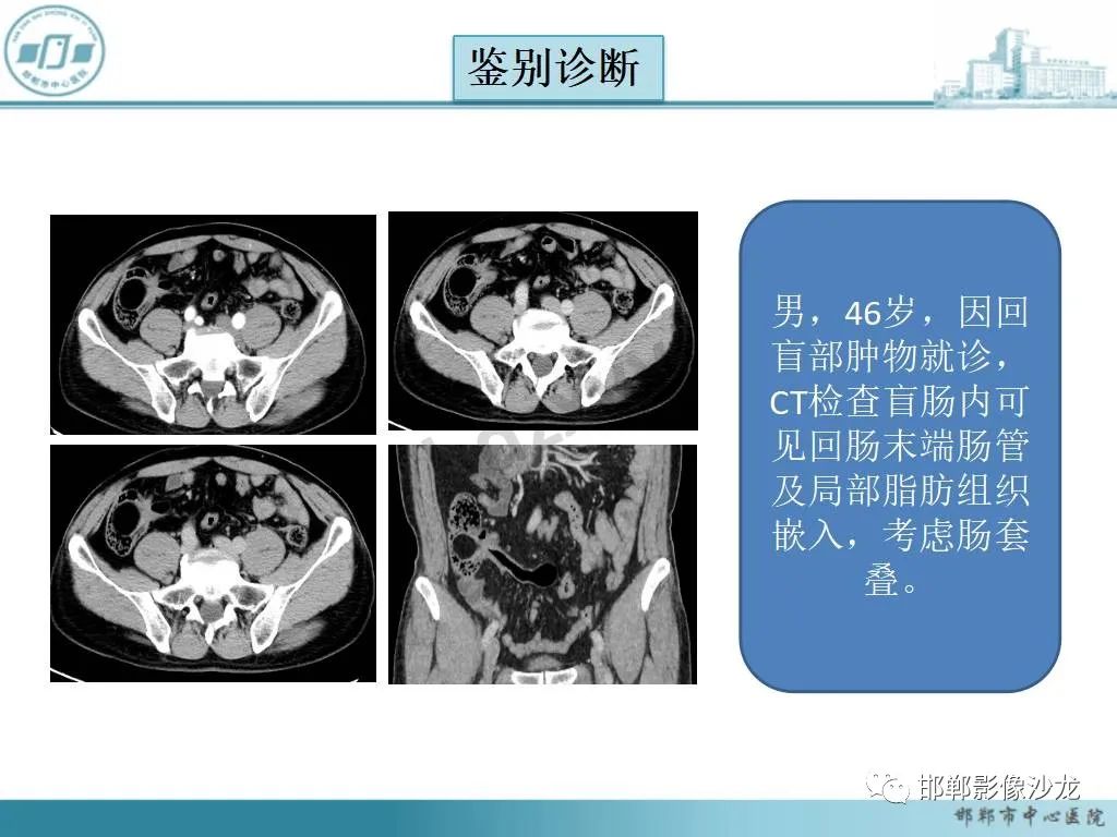 影像PPT - 【PPT】中肠旋转不良-30