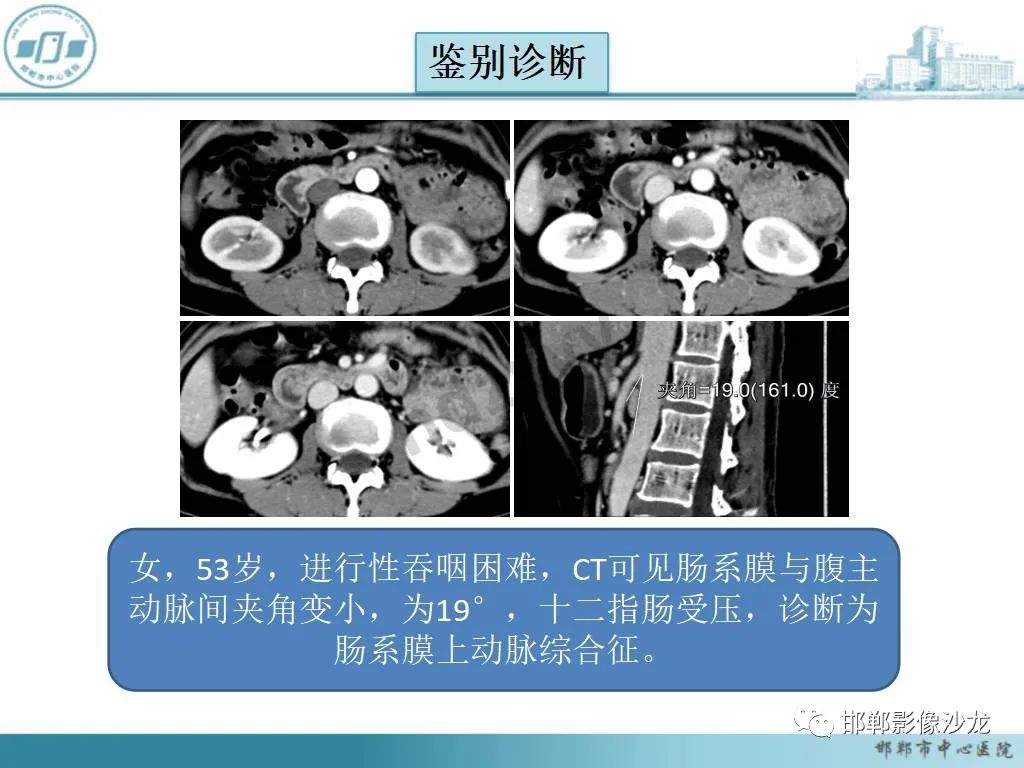 影像PPT - 【PPT】中肠旋转不良-33