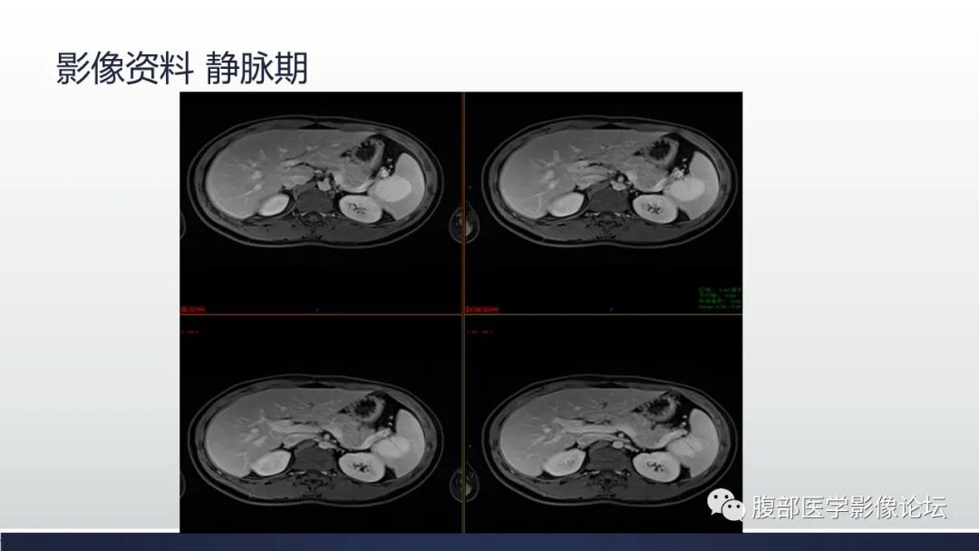 影像PPT - 【病例】脾脏窦岸细胞血管瘤1例MR影像诊断-9