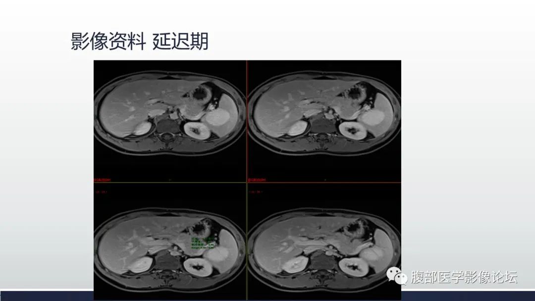影像PPT - 【病例】脾脏窦岸细胞血管瘤1例MR影像诊断-10