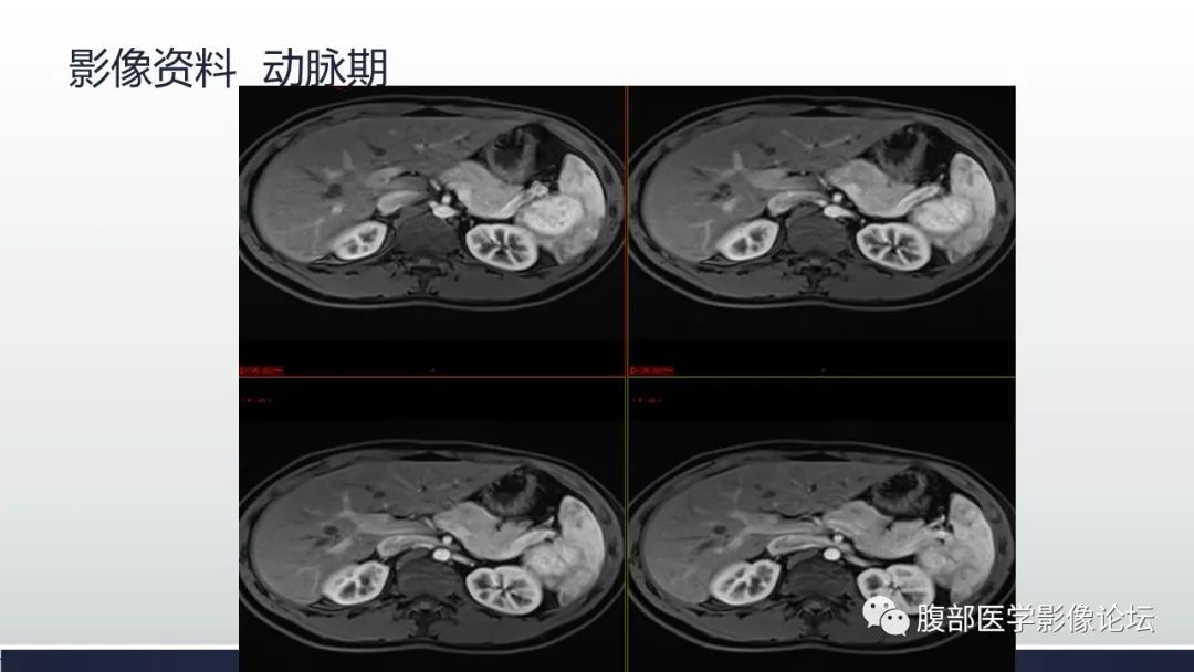 影像PPT - 【病例】脾脏窦岸细胞血管瘤1例MR影像诊断-8