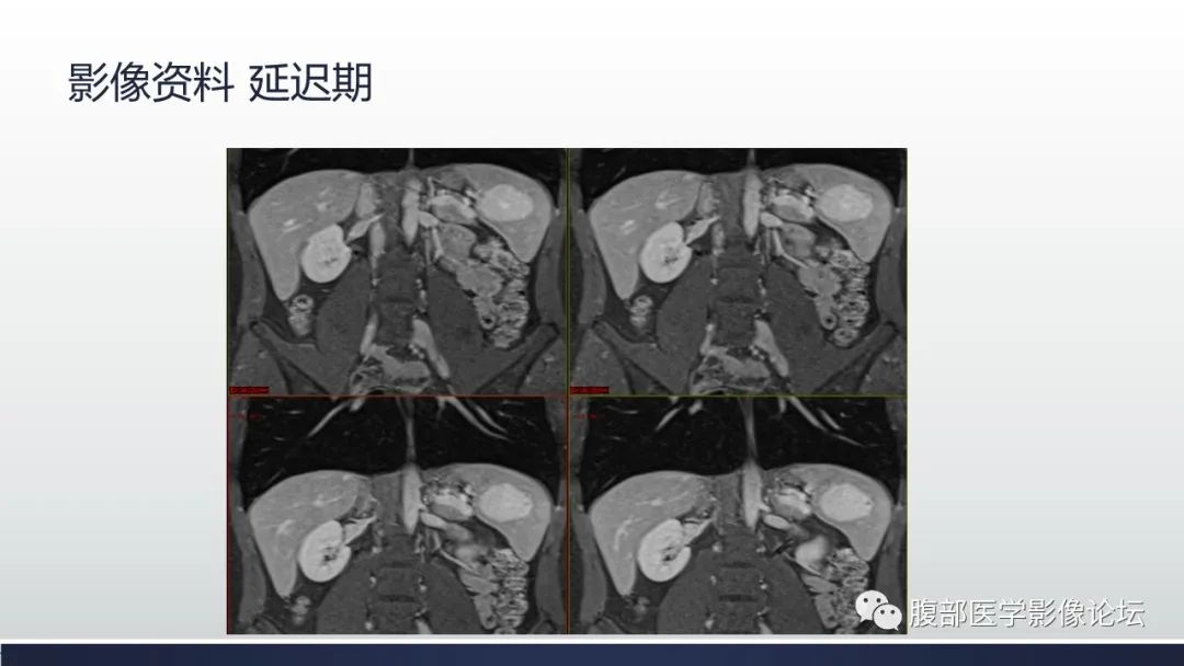 影像PPT - 【病例】脾脏窦岸细胞血管瘤1例MR影像诊断-11