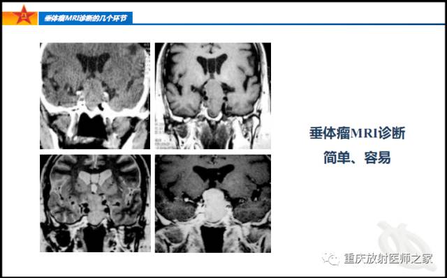 影像PPT - 【PPT】垂体瘤MRI诊断的几个环节-4