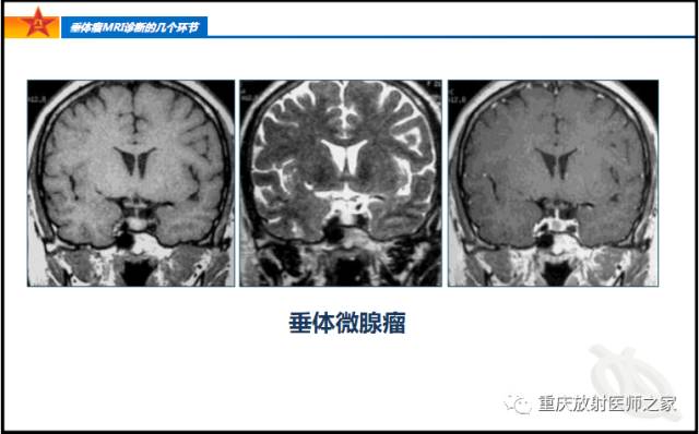 影像PPT - 【PPT】垂体瘤MRI诊断的几个环节-8