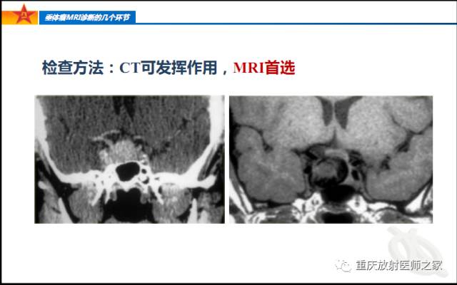 影像PPT - 【PPT】垂体瘤MRI诊断的几个环节-10