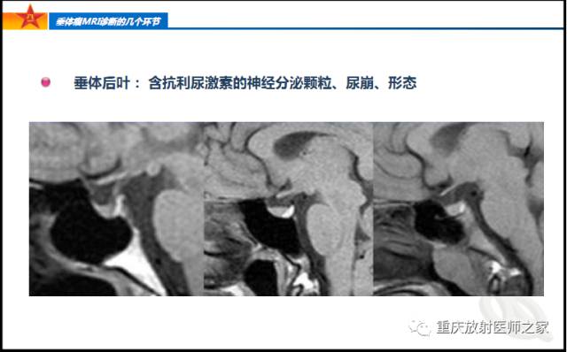 影像PPT - 【PPT】垂体瘤MRI诊断的几个环节-11