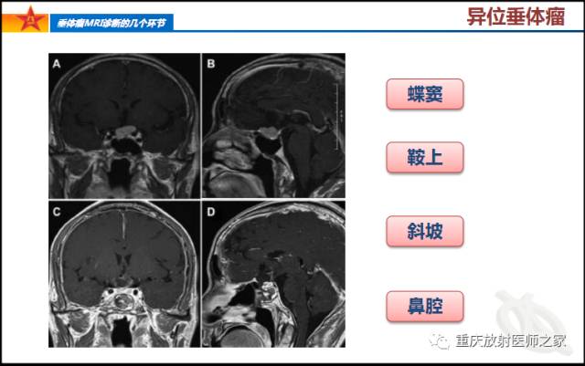 影像PPT - 【PPT】垂体瘤MRI诊断的几个环节-19