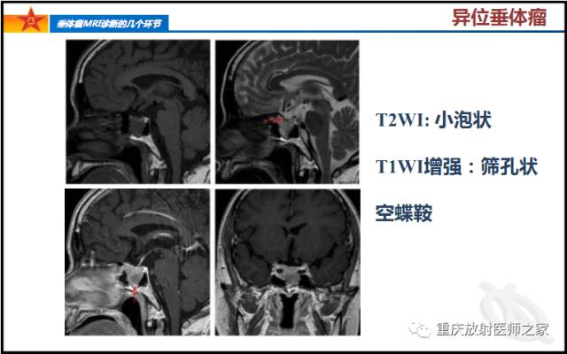 影像PPT - 【PPT】垂体瘤MRI诊断的几个环节-20
