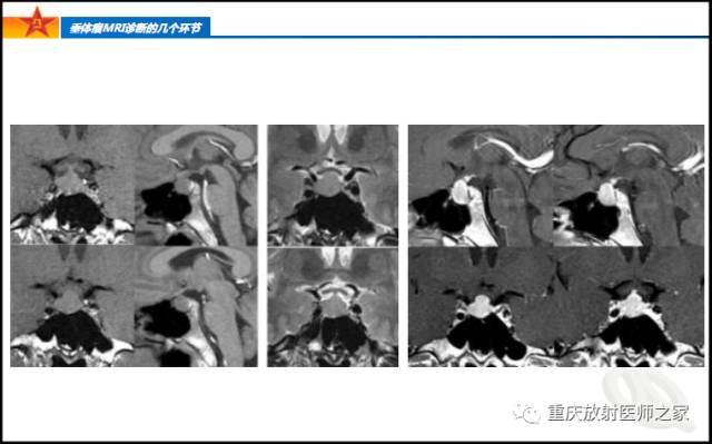 影像PPT - 【PPT】垂体瘤MRI诊断的几个环节-24