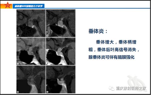 影像PPT - 【PPT】垂体瘤MRI诊断的几个环节-26