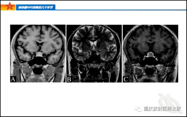 影像PPT - 【PPT】垂体瘤MRI诊断的几个环节-31