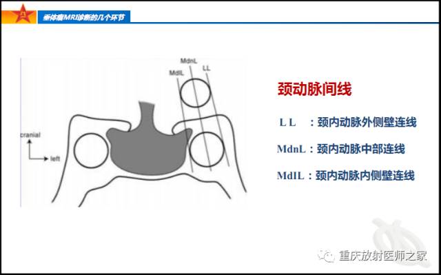 影像PPT - 【PPT】垂体瘤MRI诊断的几个环节-35