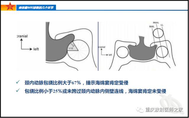 影像PPT - 【PPT】垂体瘤MRI诊断的几个环节-37