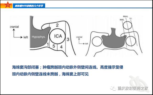 影像PPT - 【PPT】垂体瘤MRI诊断的几个环节-38