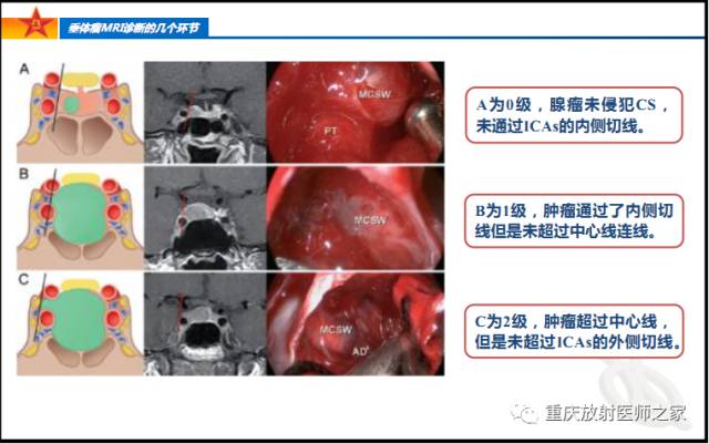 影像PPT - 【PPT】垂体瘤MRI诊断的几个环节-39