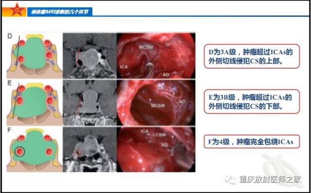 影像PPT - 【PPT】垂体瘤MRI诊断的几个环节-40