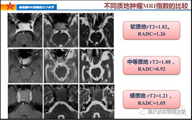 影像PPT - 【PPT】垂体瘤MRI诊断的几个环节-49