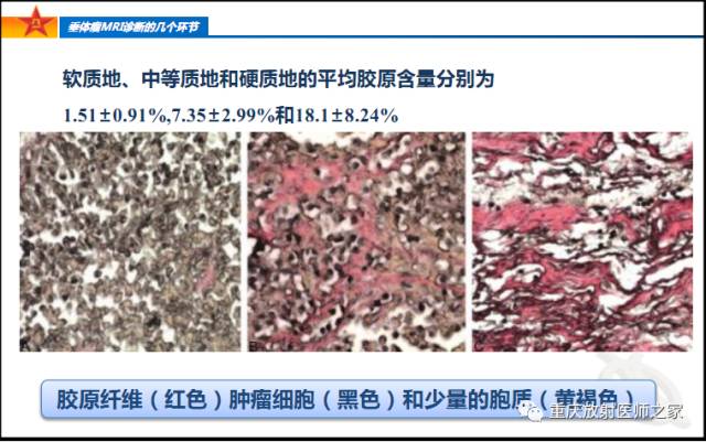 影像PPT - 【PPT】垂体瘤MRI诊断的几个环节-51