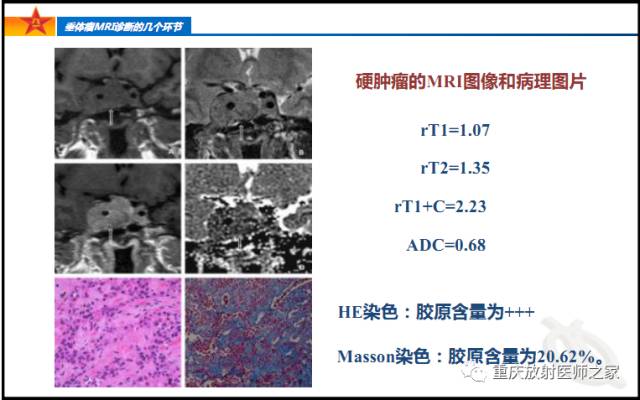 影像PPT - 【PPT】垂体瘤MRI诊断的几个环节-59