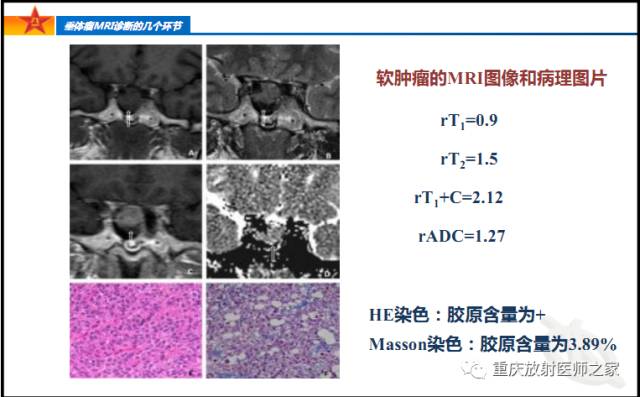 影像PPT - 【PPT】垂体瘤MRI诊断的几个环节-60