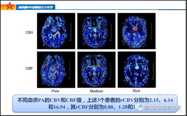 影像PPT - 【PPT】垂体瘤MRI诊断的几个环节-65