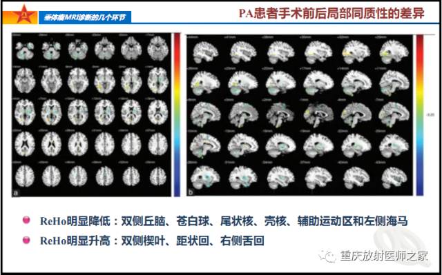 影像PPT - 【PPT】垂体瘤MRI诊断的几个环节-69