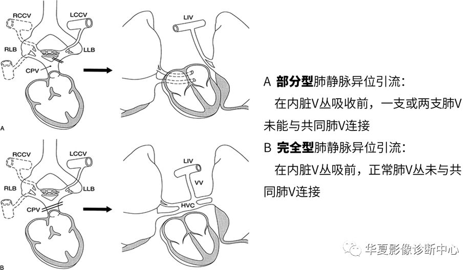 影像PPT - 弯刀综合征-10