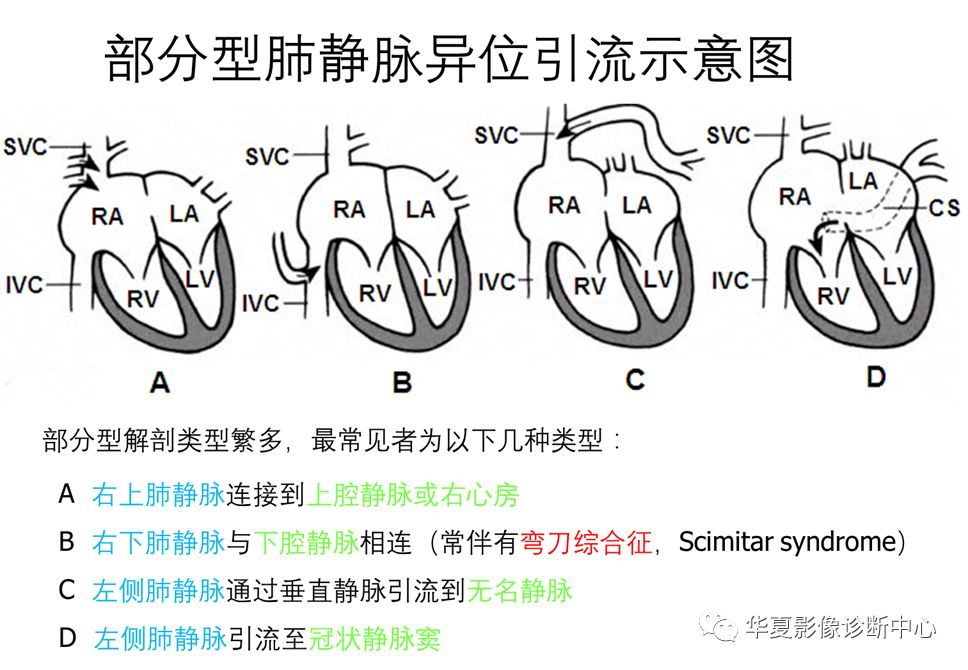 影像PPT - 弯刀综合征-13