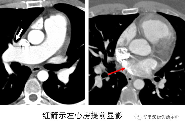 影像PPT - 弯刀综合征-16
