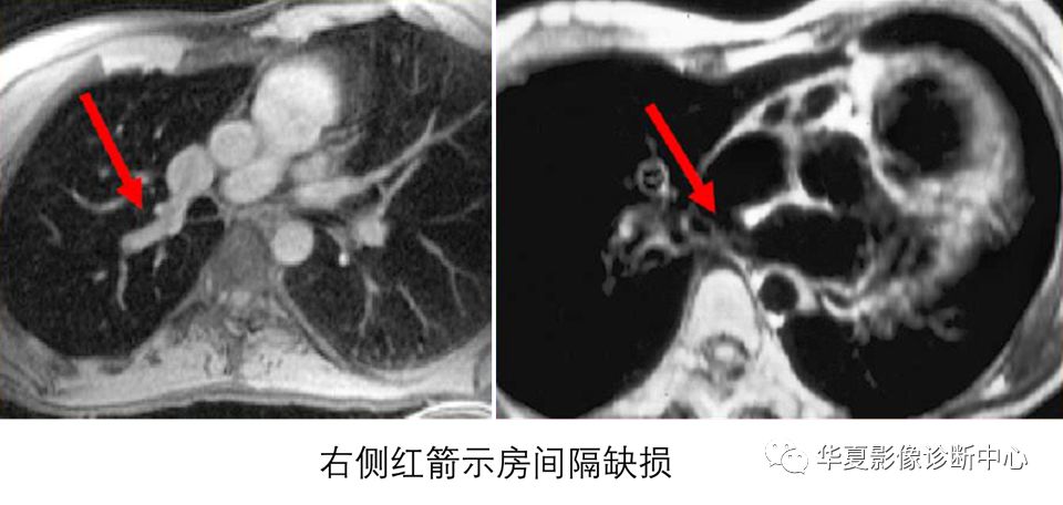 影像PPT - 弯刀综合征-17