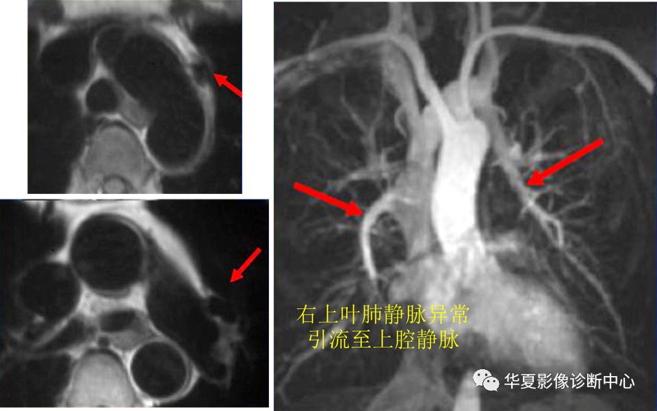影像PPT - 弯刀综合征-19