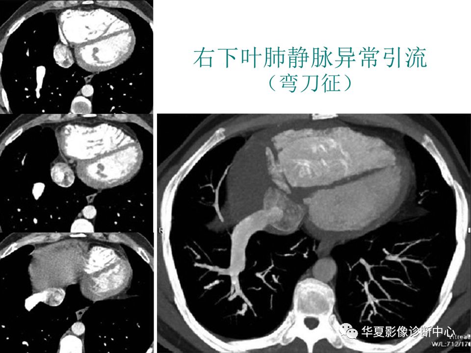 影像PPT - 弯刀综合征-21