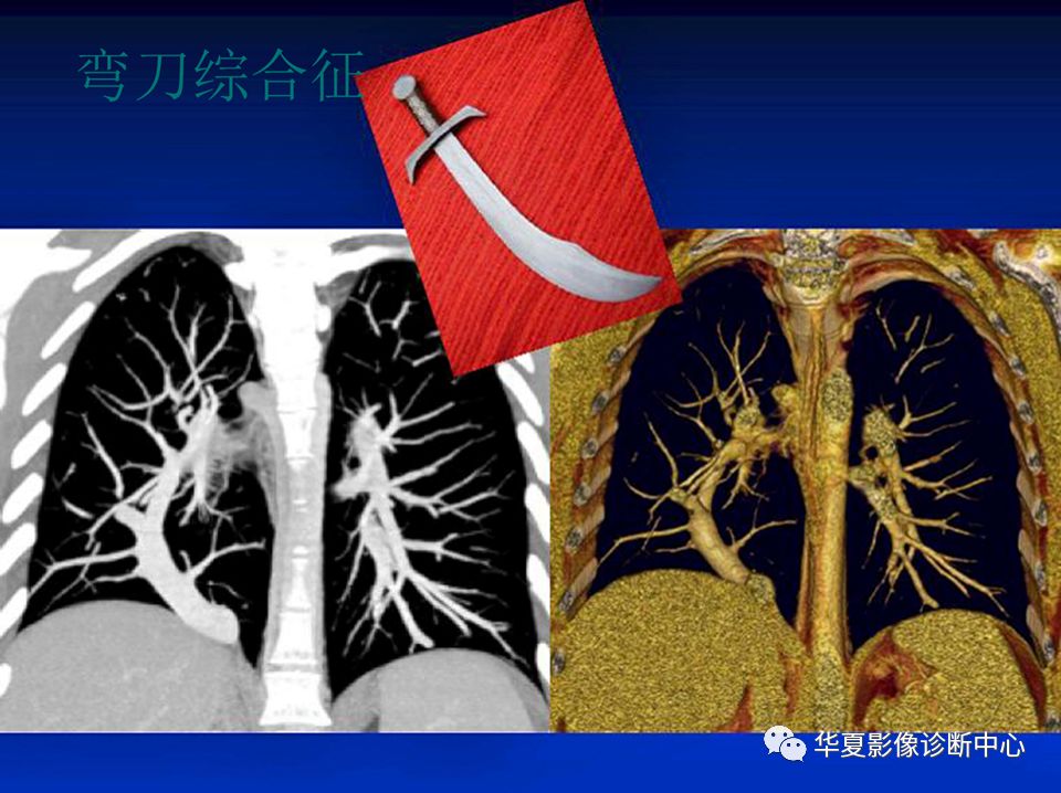 影像PPT - 弯刀综合征-23