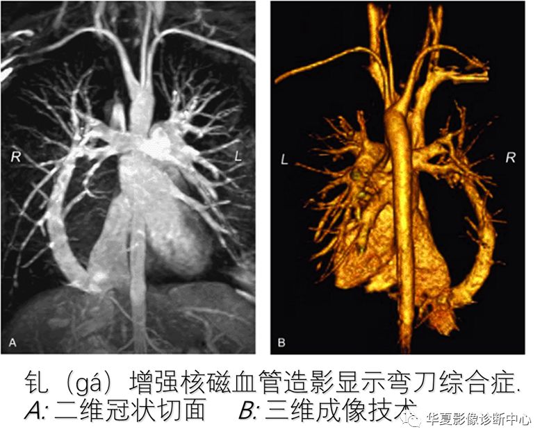 影像PPT - 弯刀综合征-25
