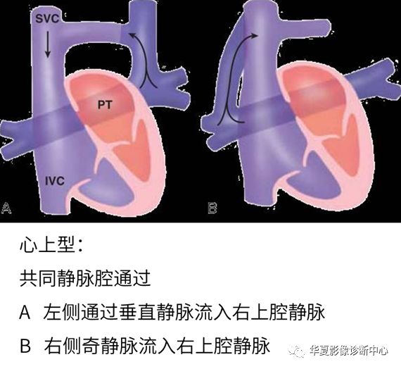 影像PPT - 弯刀综合征-27