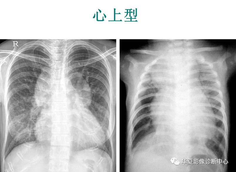 影像PPT - 弯刀综合征-28
