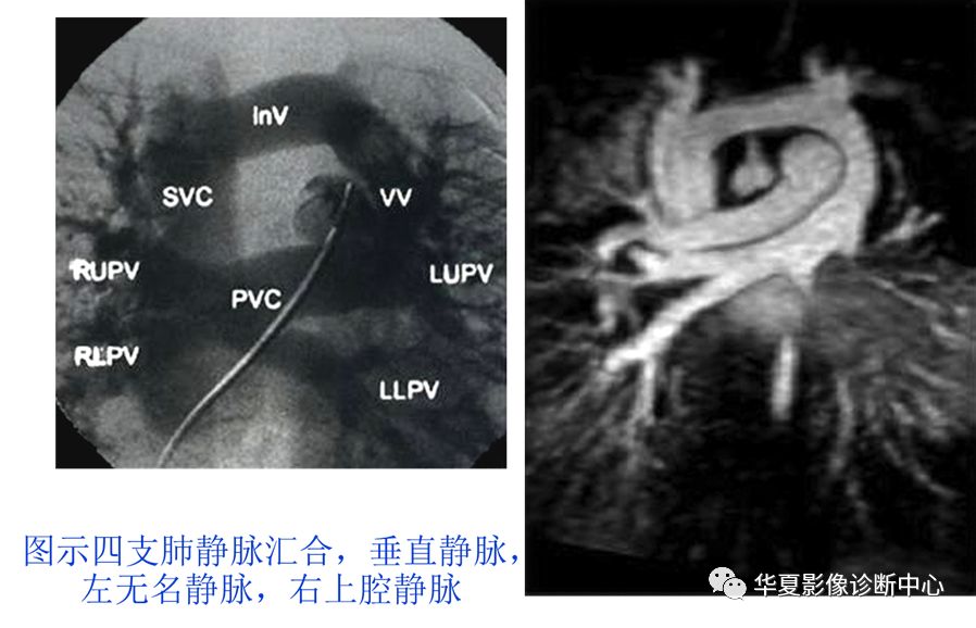 影像PPT - 弯刀综合征-29