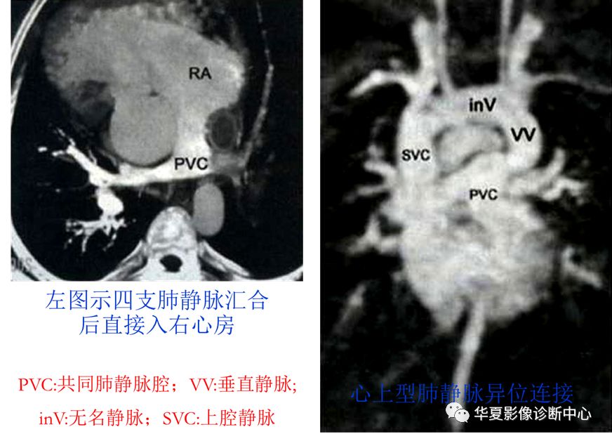 影像PPT - 弯刀综合征-30