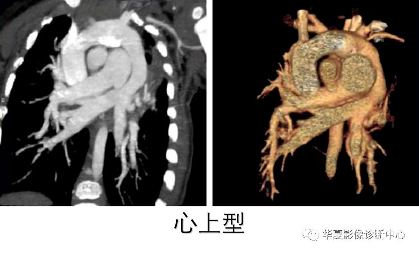 影像PPT - 弯刀综合征-31