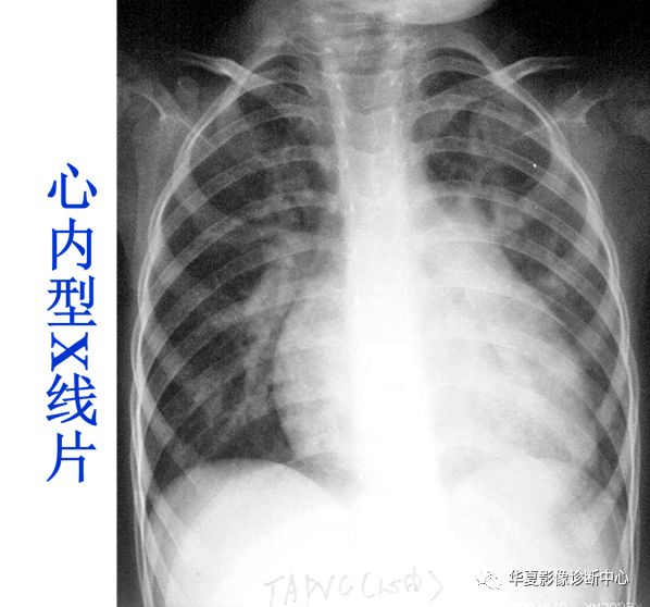 影像PPT - 弯刀综合征-35